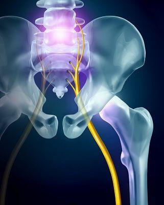 What Is Sciatica, and How Is It Treated?